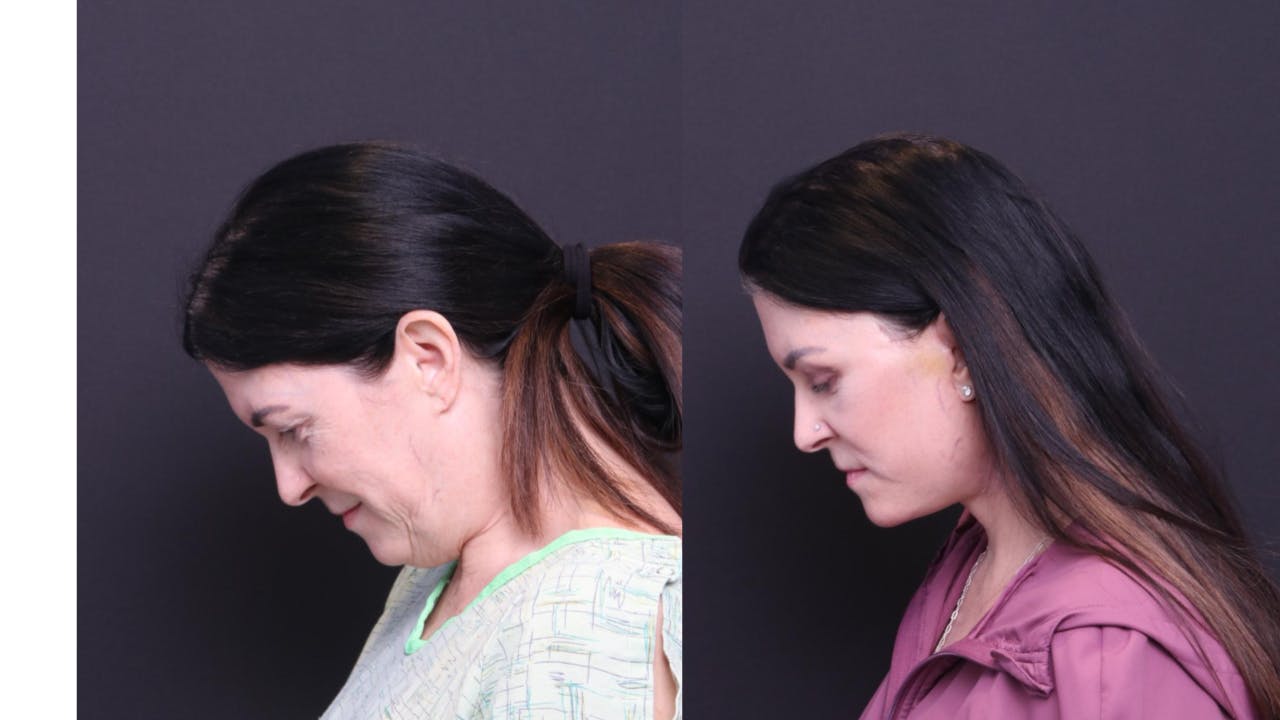 Neck Lift Before & After Gallery - Patient 318717 - Image 4