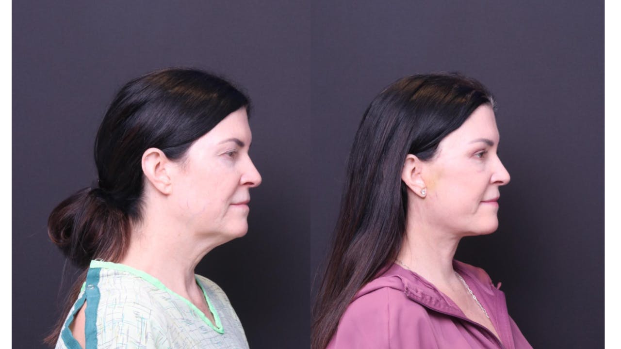Neck Lift Before & After Gallery - Patient 318717 - Image 3