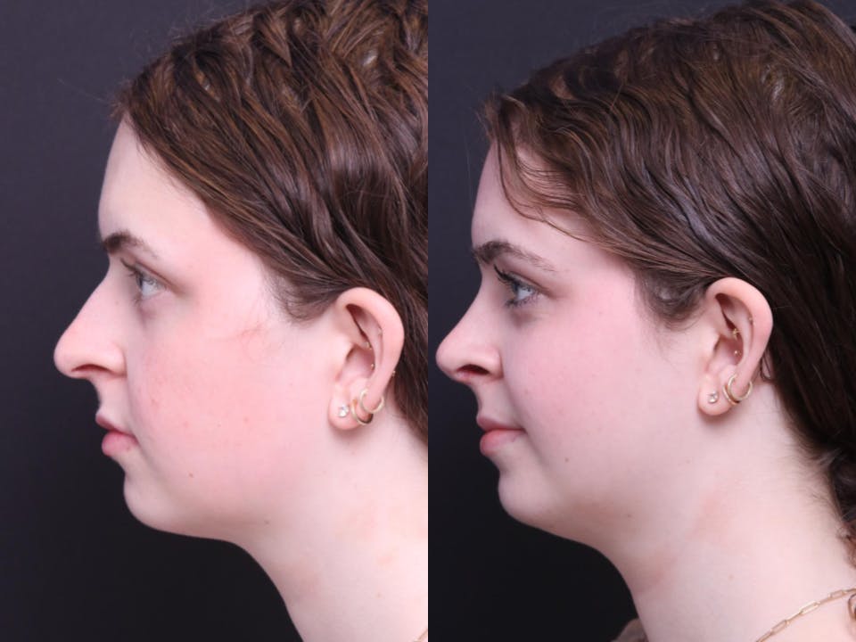 Rhinoplasty Before & After Gallery - Patient 264903 - Image 4