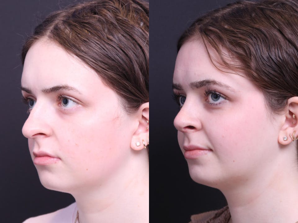 Rhinoplasty Before & After Gallery - Patient 264903 - Image 5