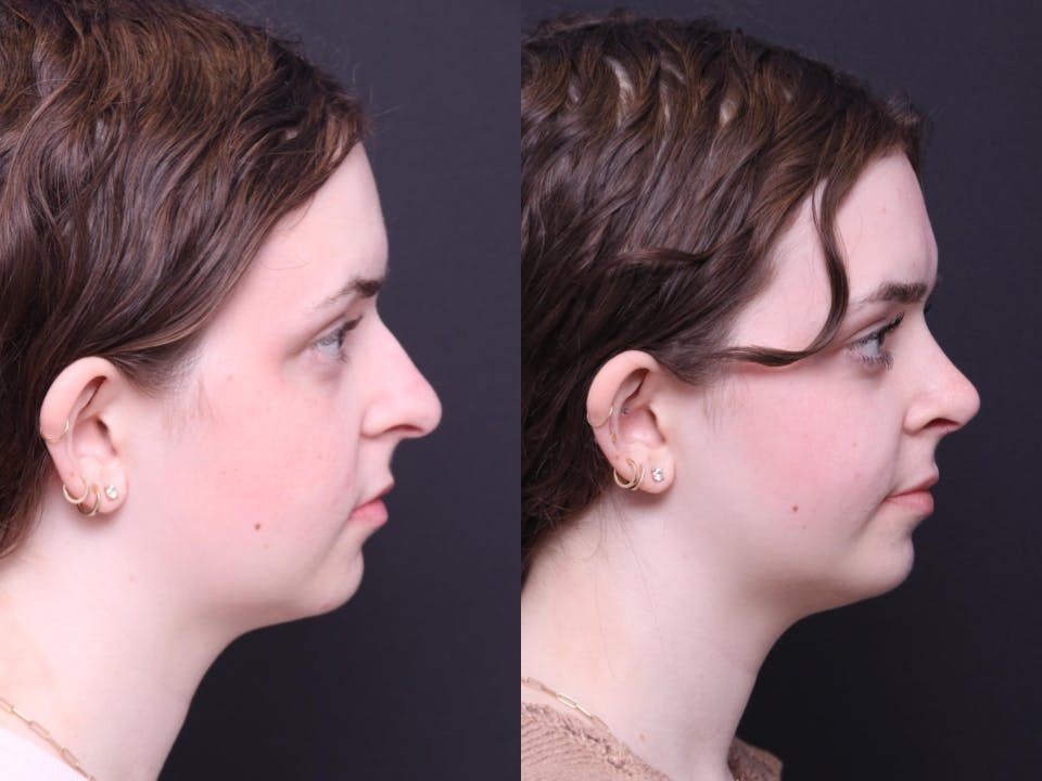 Rhinoplasty Before & After Gallery - Patient 264903 - Image 3