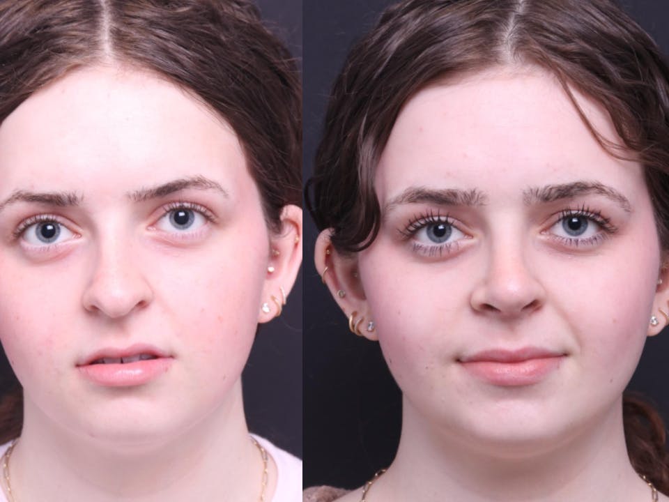 Rhinoplasty Before & After Gallery - Patient 264903 - Image 1