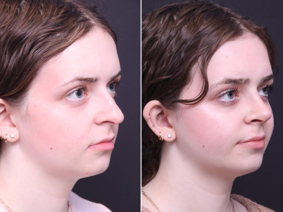 Rhinoplasty Before & After Gallery - Patient 264903 - Image 2