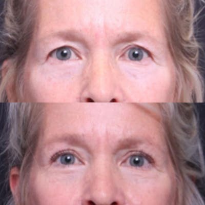 Blepharoplasty Before & After Gallery - Patient 325699 - Image 1