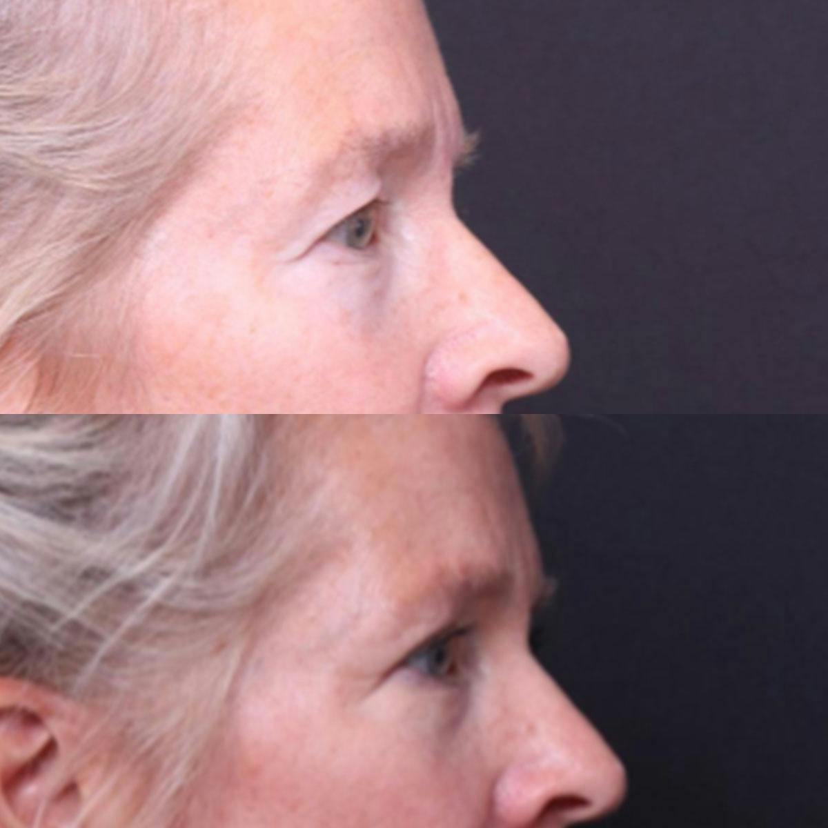 Blepharoplasty Before & After Gallery - Patient 325699 - Image 3