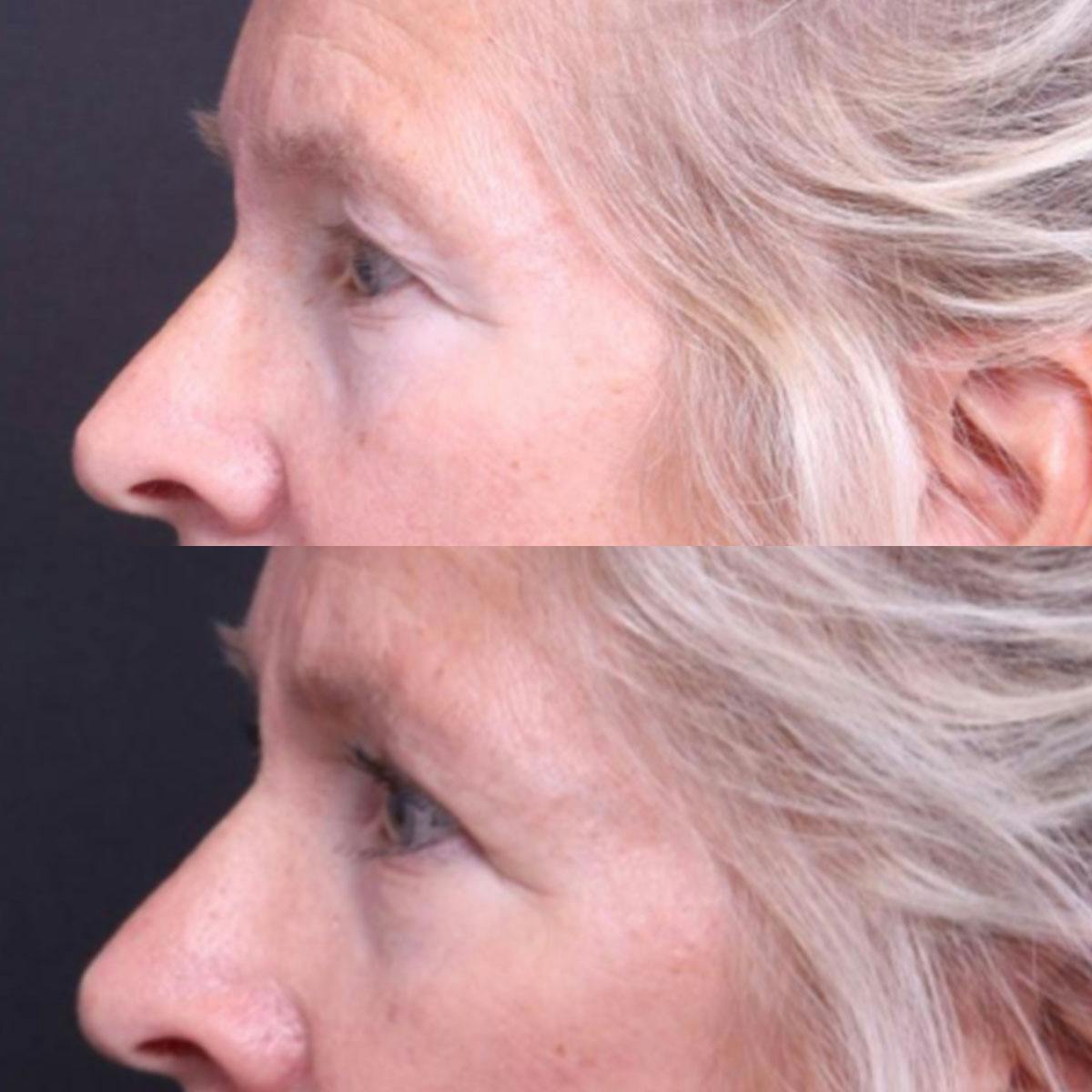 Blepharoplasty Before & After Gallery - Patient 325699 - Image 4