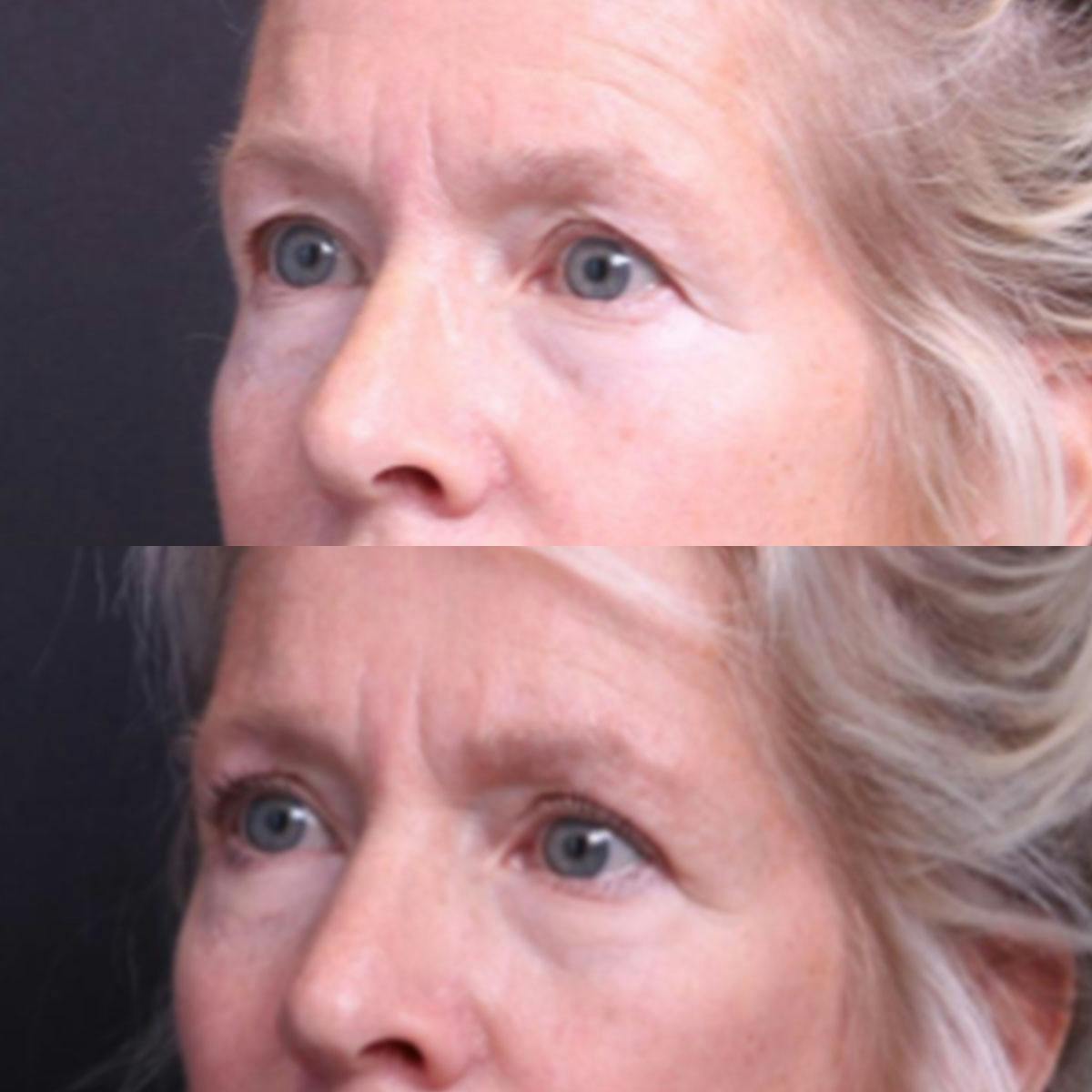 Blepharoplasty Before & After Gallery - Patient 325699 - Image 5