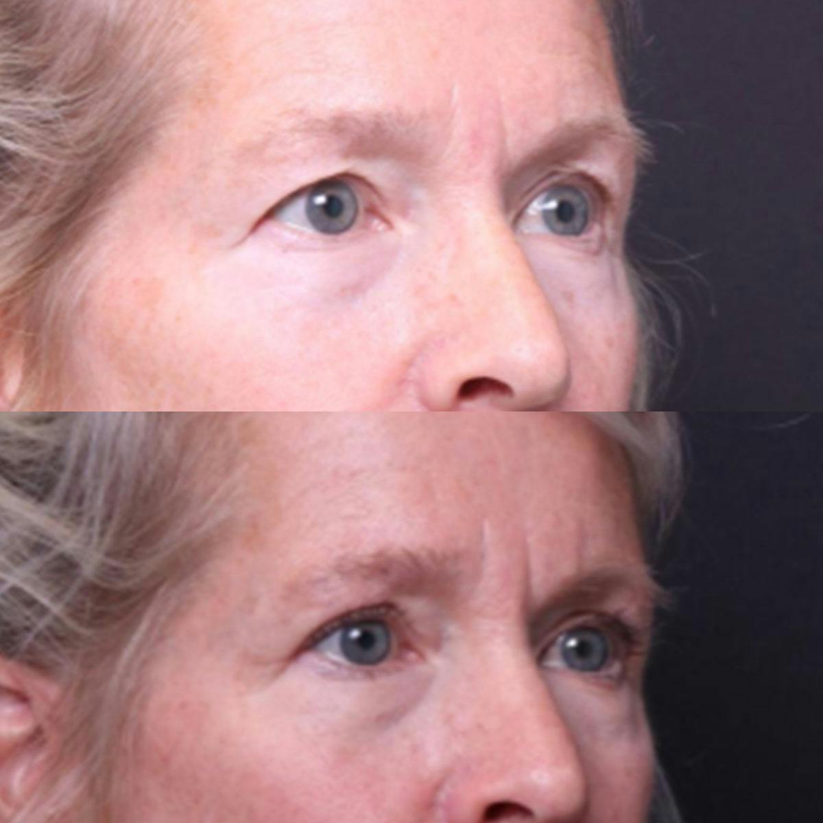 Blepharoplasty Before & After Gallery - Patient 325699 - Image 2