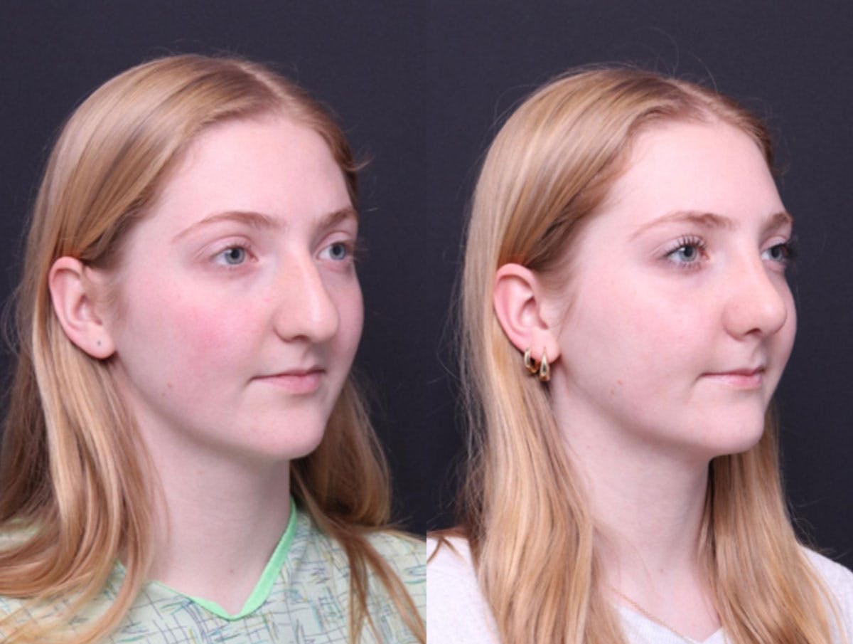 Rhinoplasty Before & After Gallery - Patient 177949 - Image 2