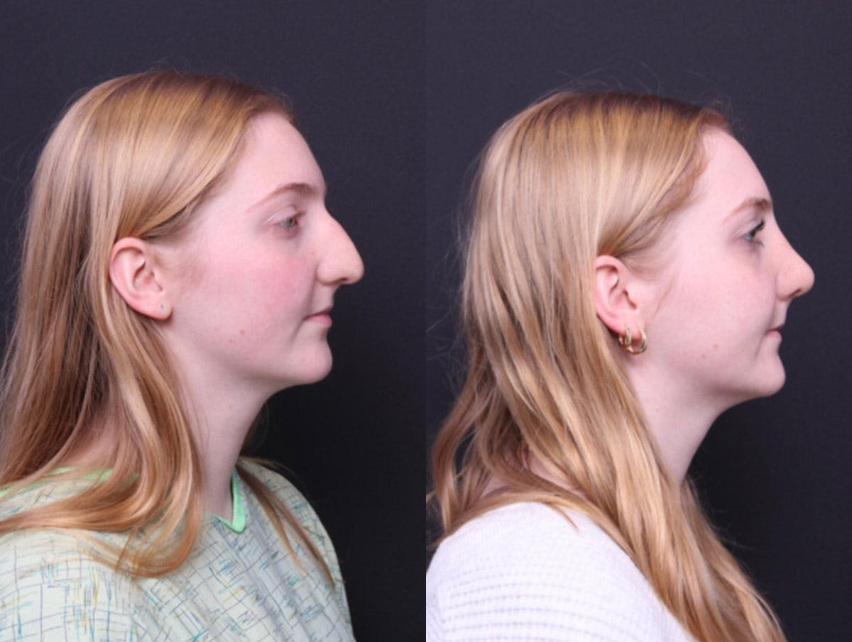 Rhinoplasty Before & After Gallery - Patient 177949 - Image 3