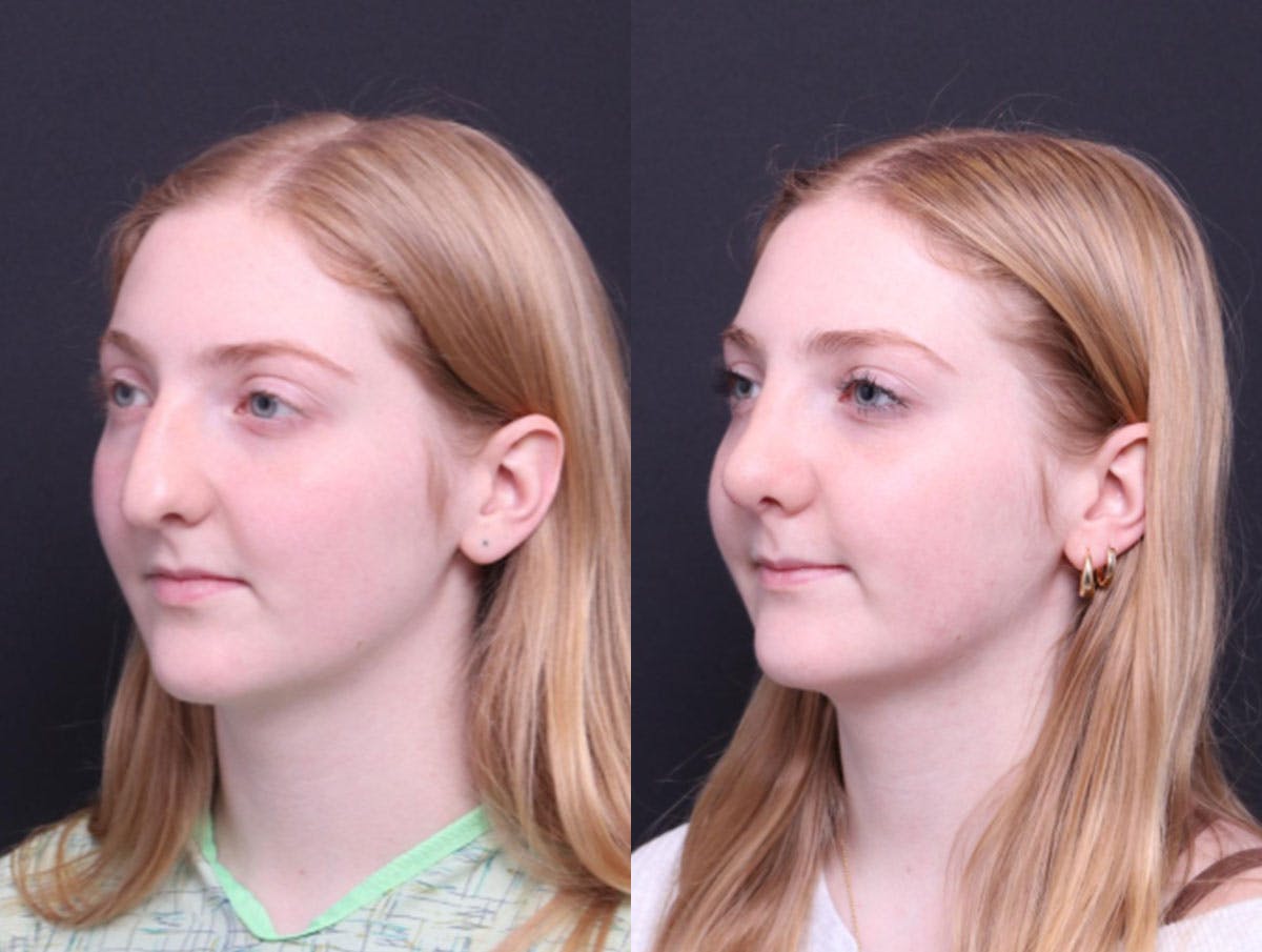 Rhinoplasty Before & After Gallery - Patient 177949 - Image 5