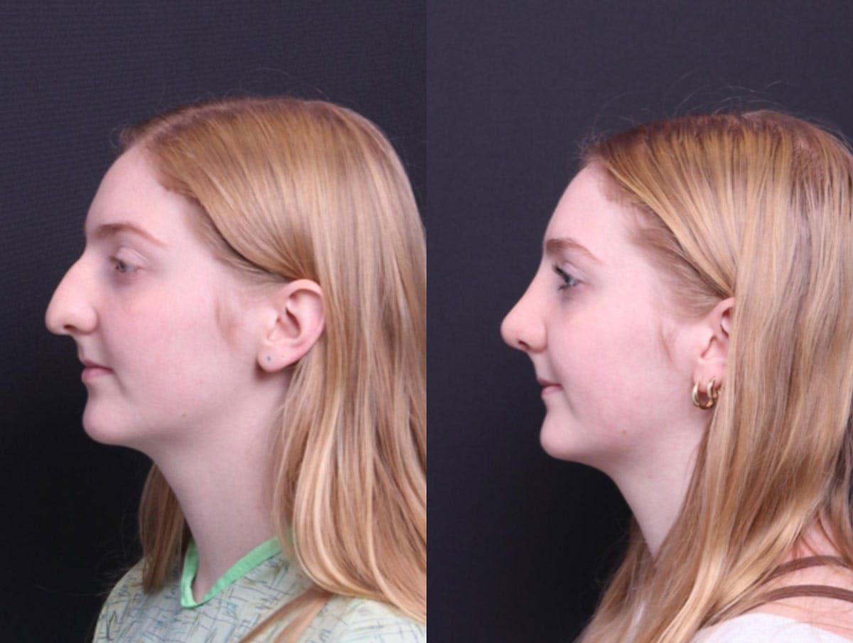 Rhinoplasty Before & After Gallery - Patient 177949 - Image 4