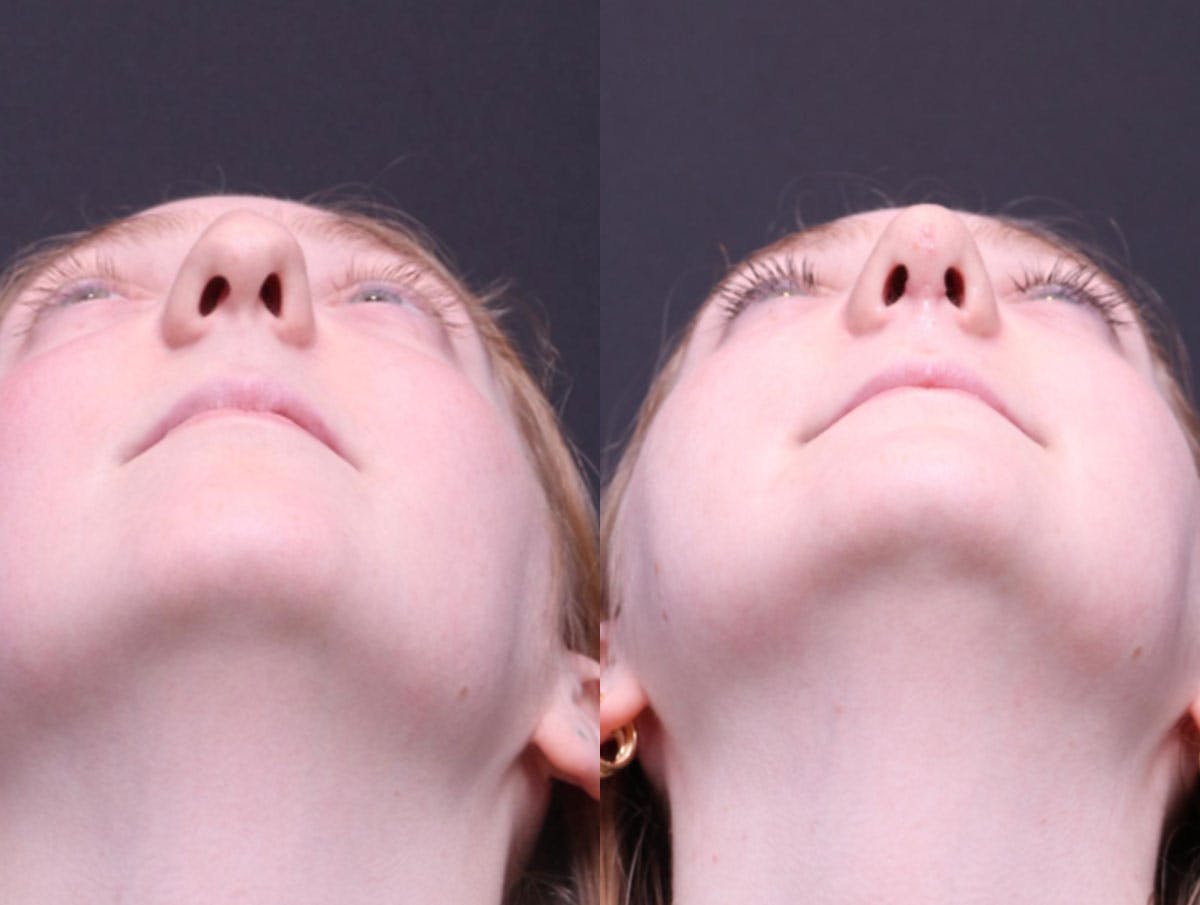 Rhinoplasty Before & After Gallery - Patient 177949 - Image 6