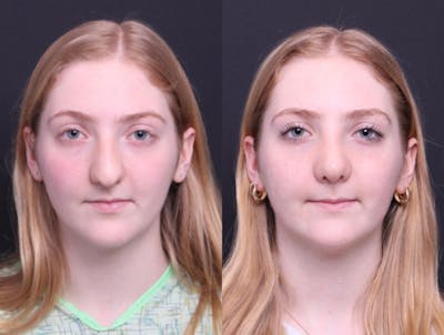 Rhinoplasty Before & After Gallery - Patient 177949 - Image 1