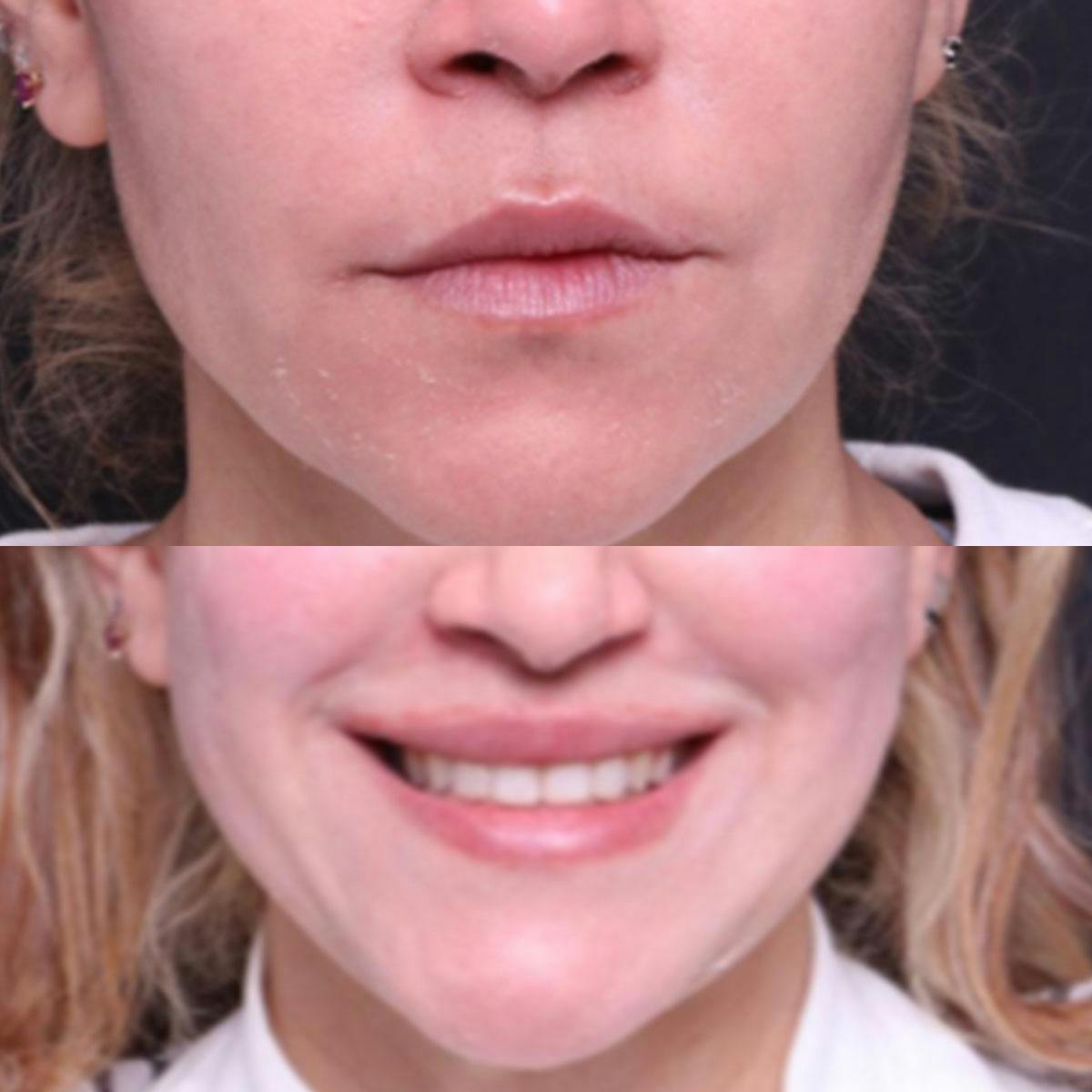 Lip Lift Before & After Gallery - Patient 149400 - Image 2