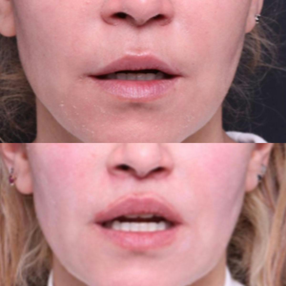 Lip Lift Before & After Gallery - Patient 149400 - Image 3