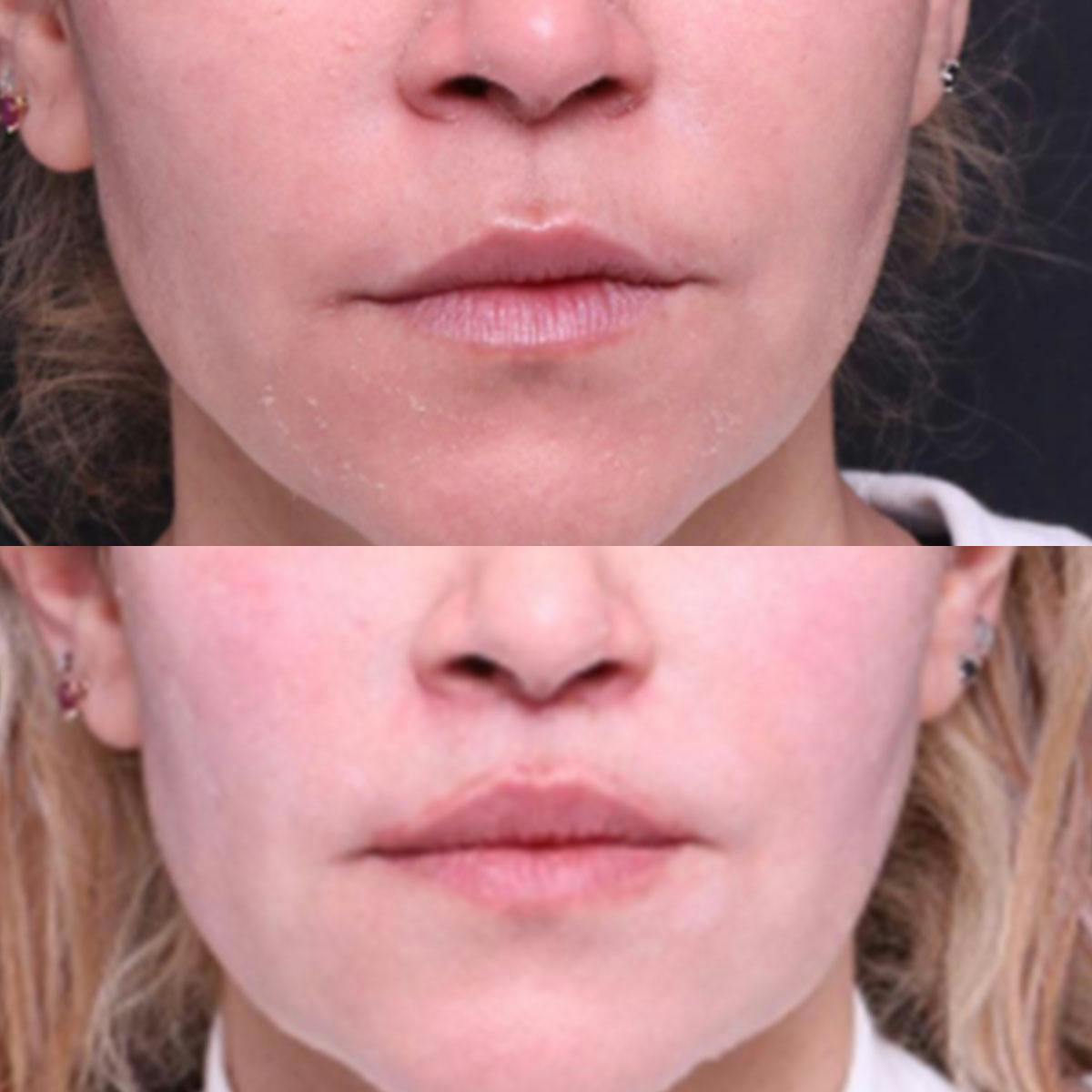 Lip Lift Before & After Gallery - Patient 149400 - Image 1