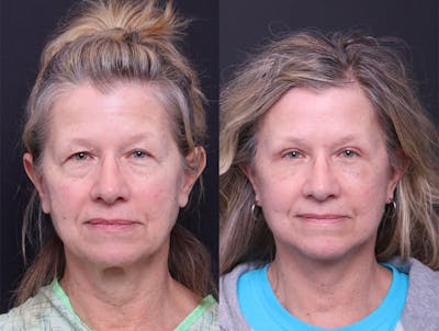 Deep Plane Facelift Before & After Gallery - Patient 390944 - Image 1