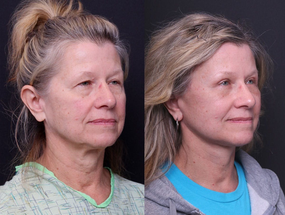 Deep Plane Facelift Before & After Gallery - Patient 390944 - Image 2