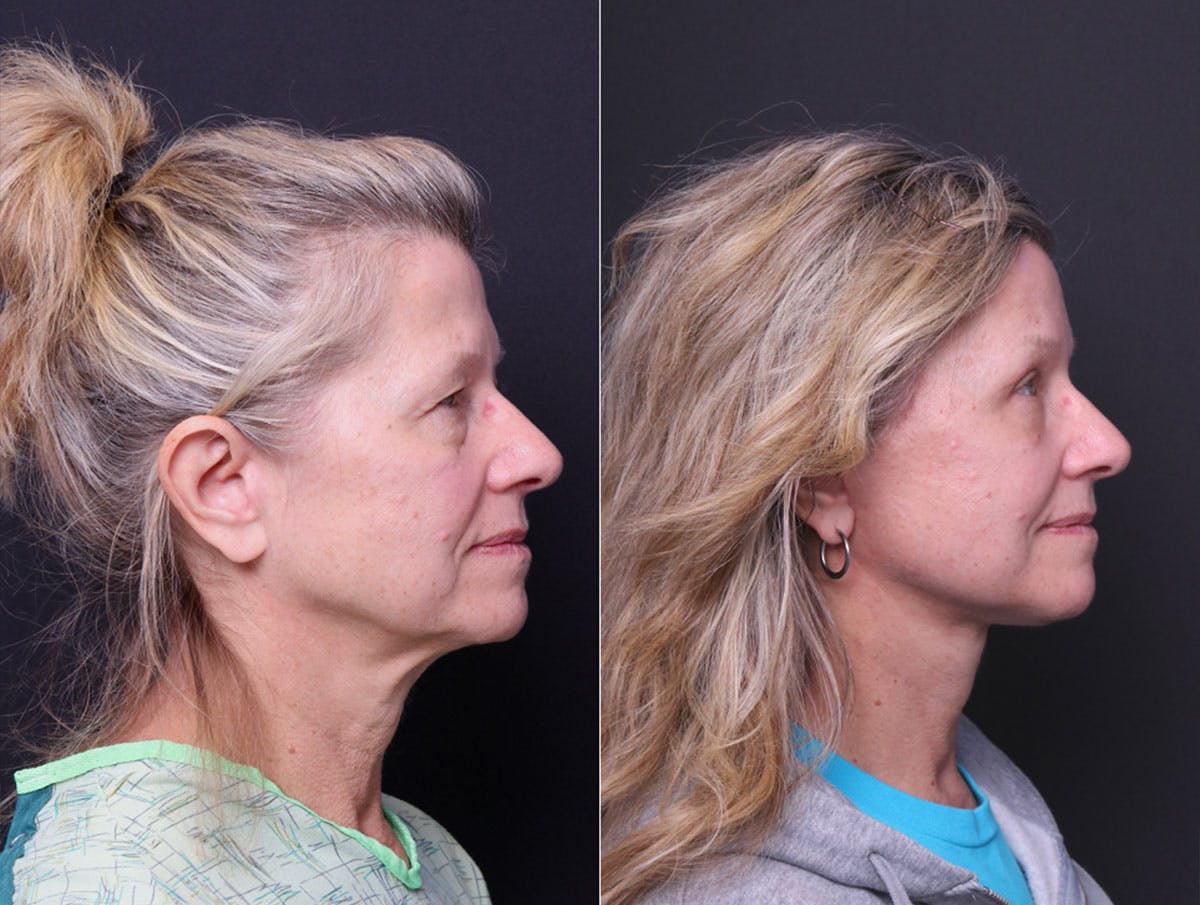 Deep Plane Facelift Before & After Gallery - Patient 390944 - Image 3