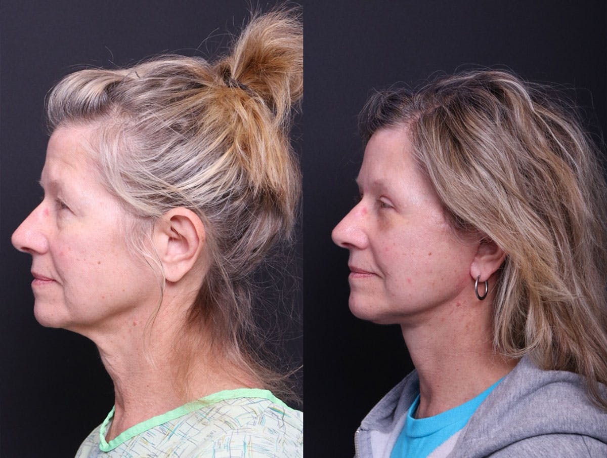 Deep Plane Facelift Before & After Gallery - Patient 390944 - Image 4
