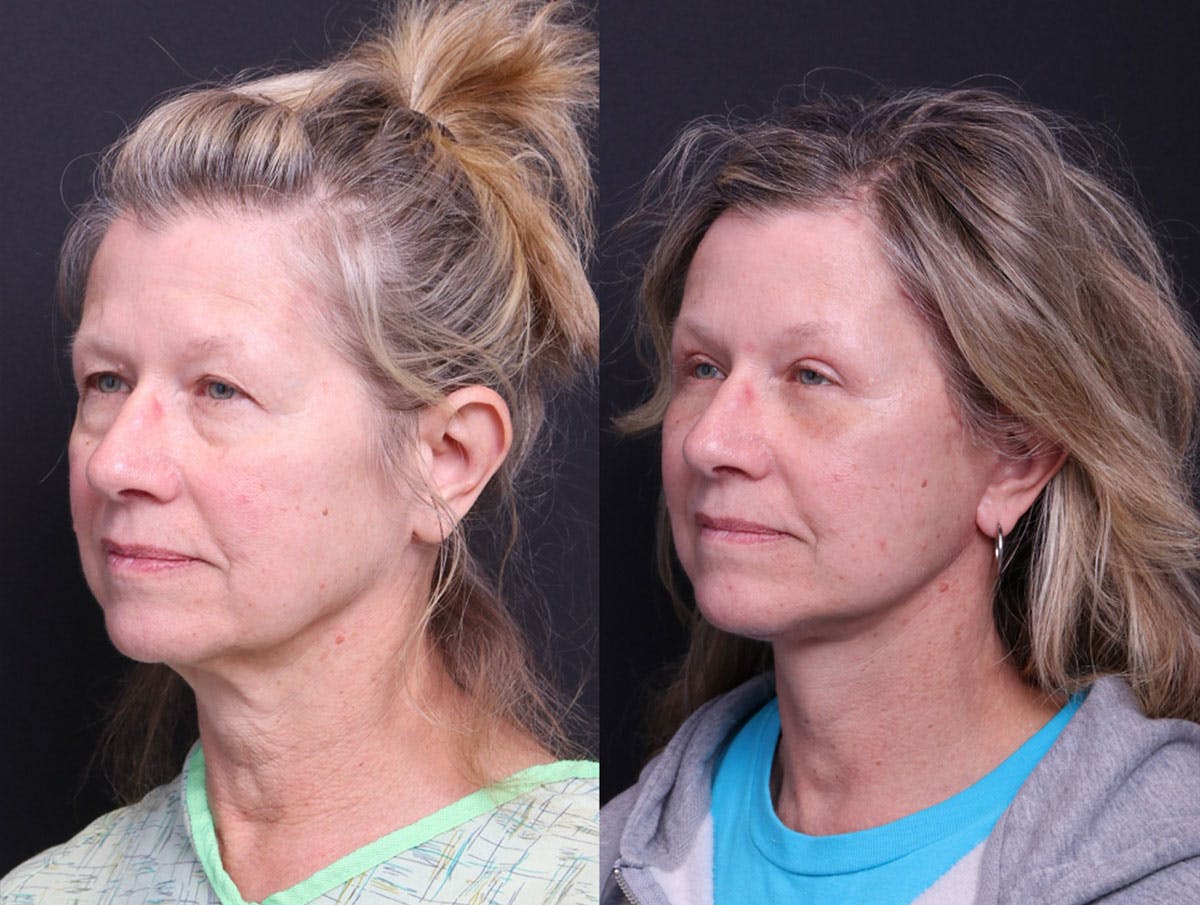 Deep Plane Facelift Before & After Gallery - Patient 390944 - Image 5