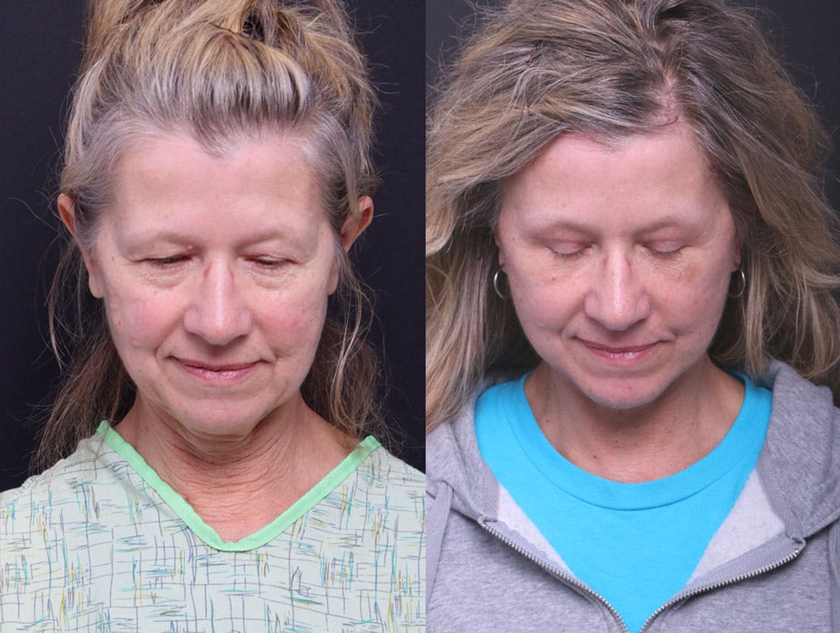 Deep Plane Facelift Before & After Gallery - Patient 390944 - Image 9