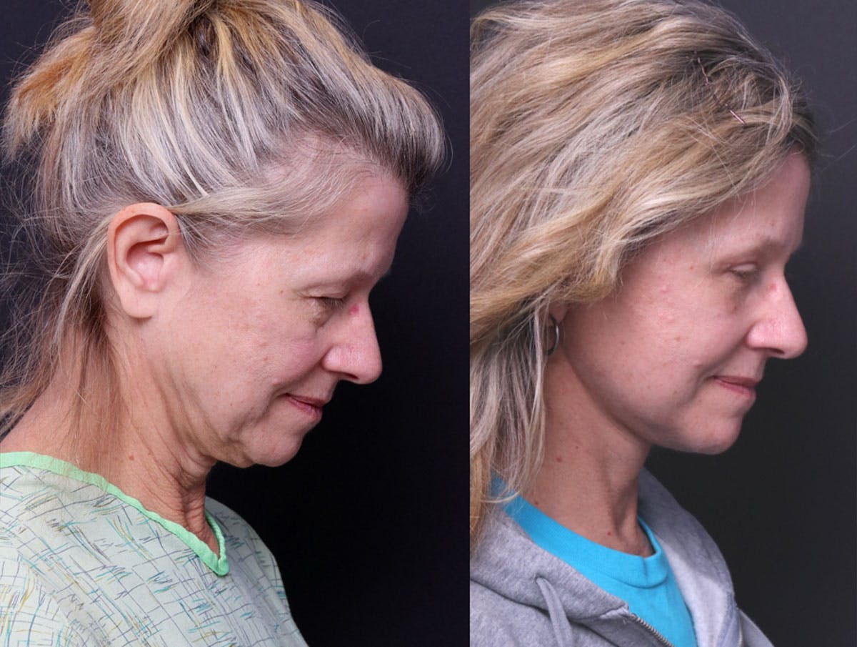Deep Plane Facelift Before & After Gallery - Patient 390944 - Image 8