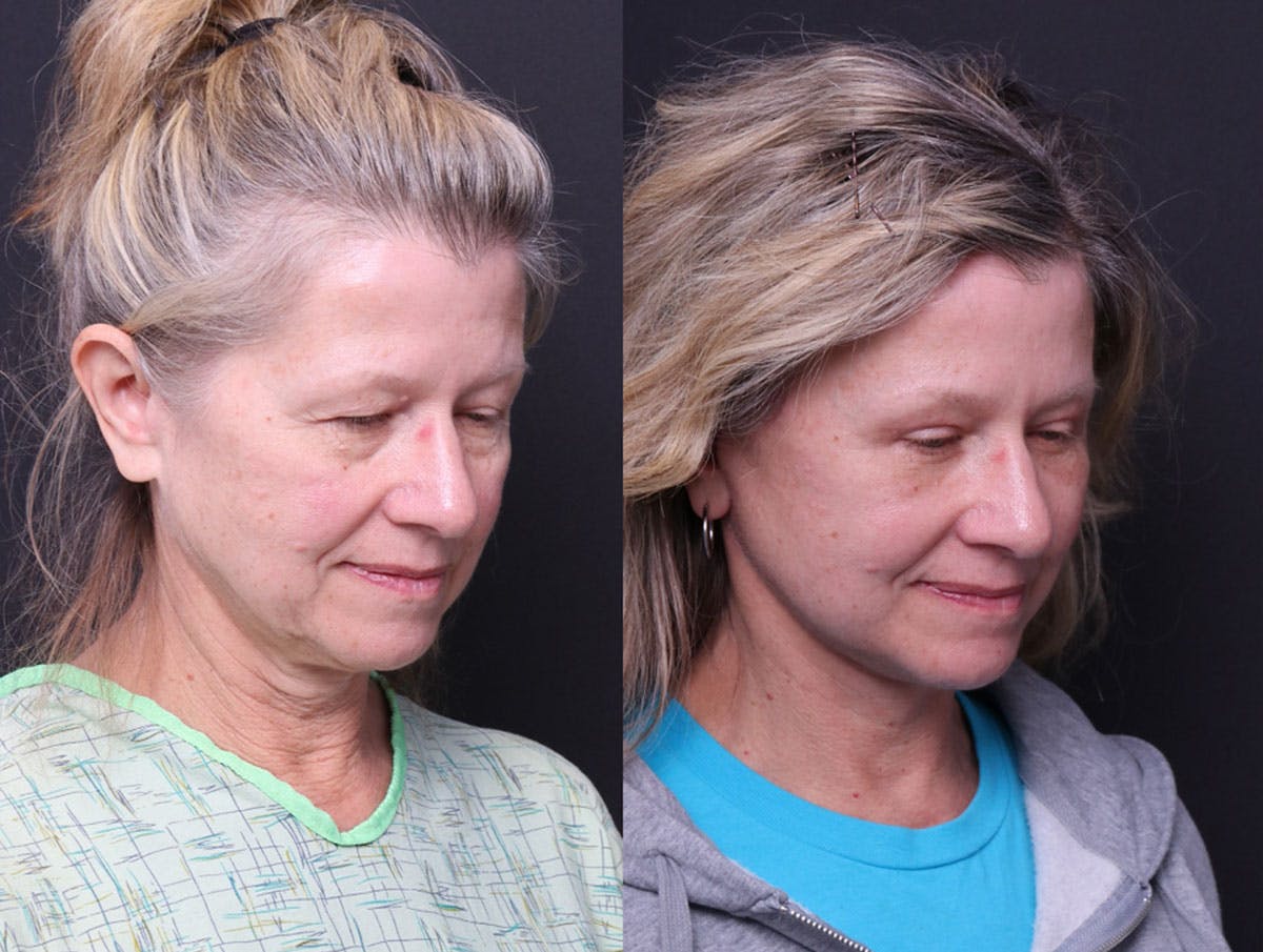 Deep Plane Facelift Before & After Gallery - Patient 390944 - Image 7