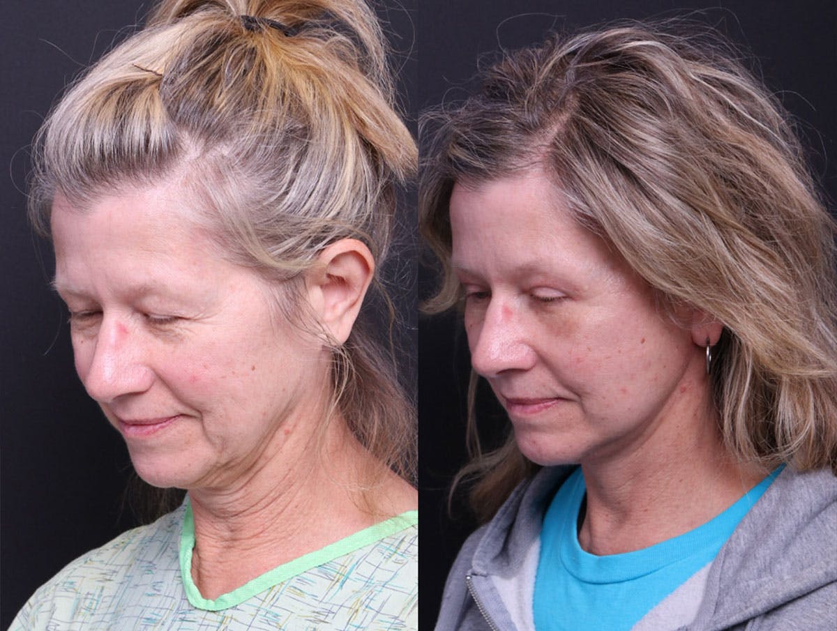 Deep Plane Facelift Before & After Gallery - Patient 390944 - Image 6