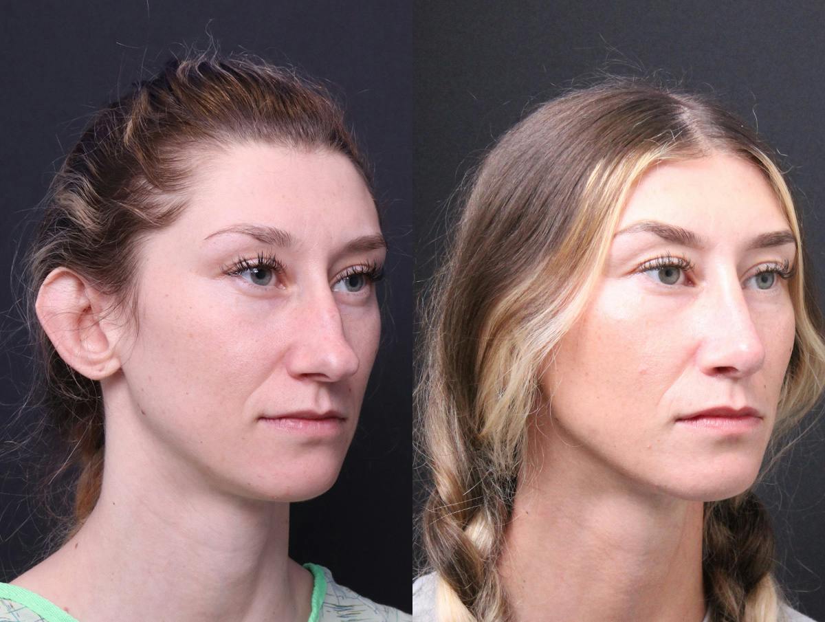 Rhinoplasty Before & After Gallery - Patient 216294 - Image 2