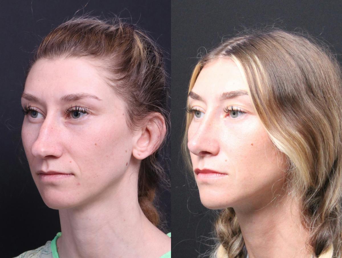 Rhinoplasty Before & After Gallery - Patient 216294 - Image 4