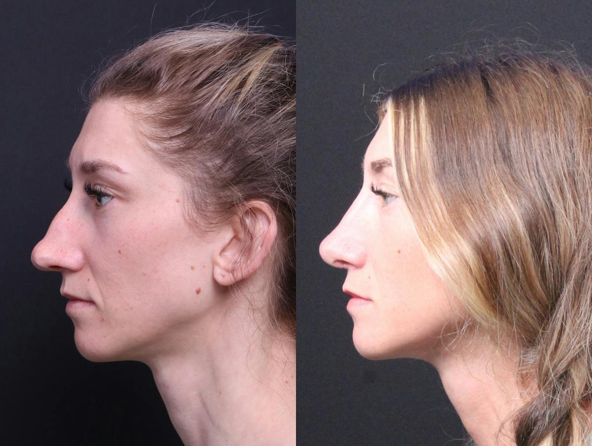 Rhinoplasty Before & After Gallery - Patient 216294 - Image 5
