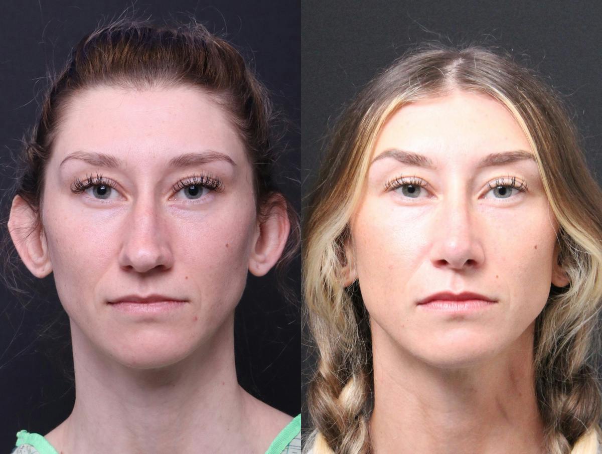 Rhinoplasty Before & After Gallery - Patient 216294 - Image 1