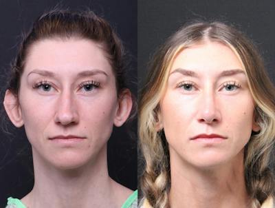 Rhinoplasty Before & After Gallery - Patient 216294 - Image 1
