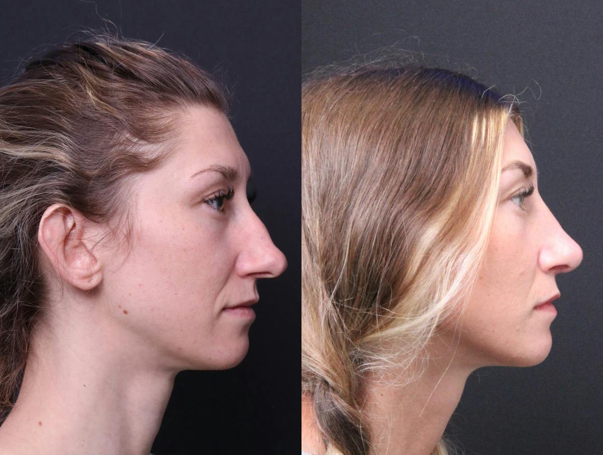 Rhinoplasty Before & After Gallery - Patient 216294 - Image 3