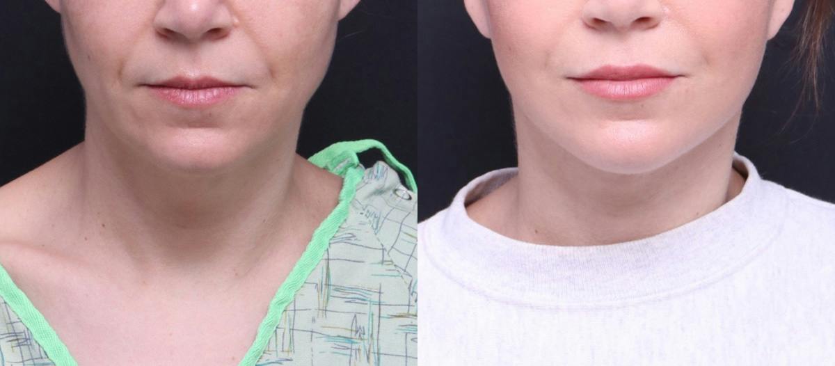 Deep Plane Facelift Before & After Gallery - Patient 464783 - Image 1