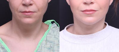 Deep Plane Facelift Before & After Gallery - Patient 464783 - Image 1