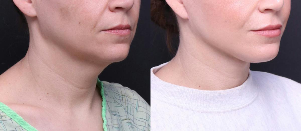 Deep Plane Facelift Before & After Gallery - Patient 464783 - Image 2