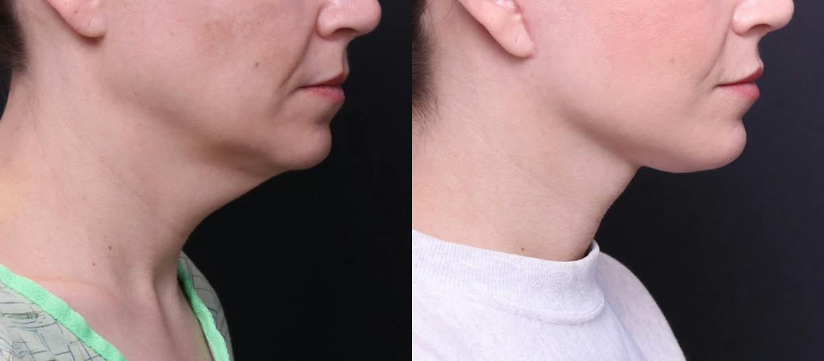 Deep Plane Facelift Before & After Gallery - Patient 464783 - Image 3
