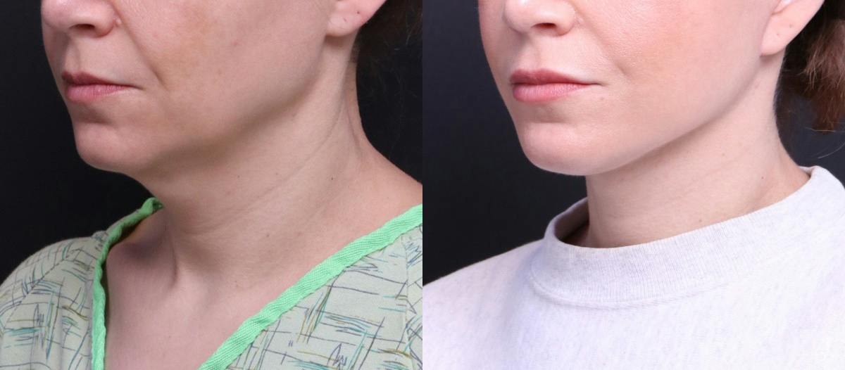 Deep Plane Facelift Before & After Gallery - Patient 464783 - Image 4
