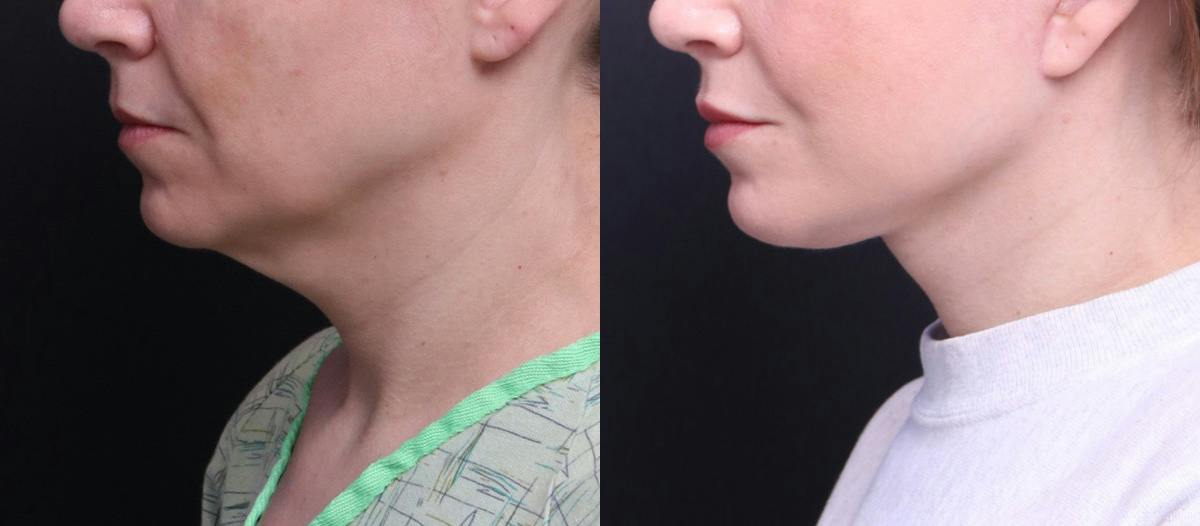 Deep Plane Facelift Before & After Gallery - Patient 464783 - Image 5