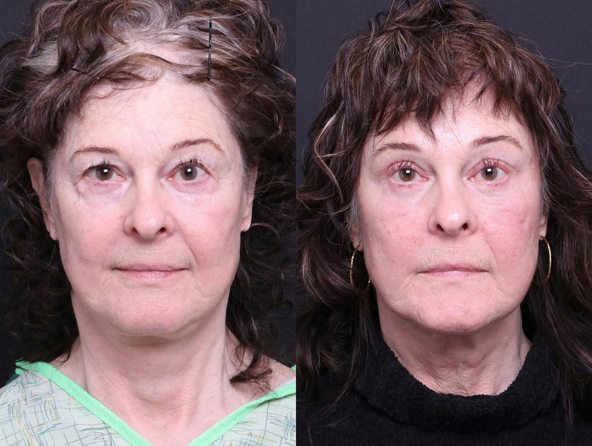 Blepharoplasty Before & After Gallery - Patient 238919 - Image 1