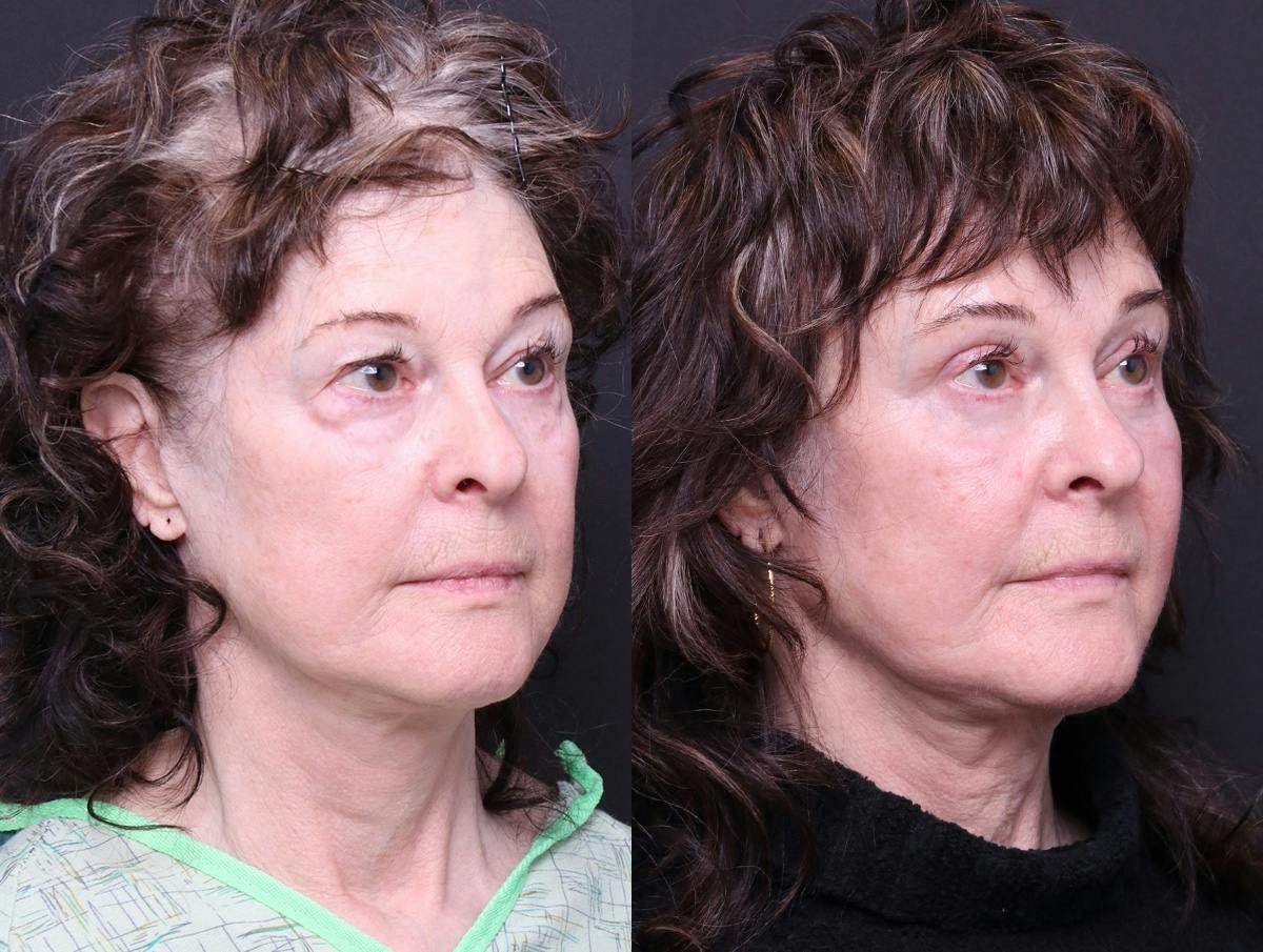 Blepharoplasty Before & After Gallery - Patient 238919 - Image 2