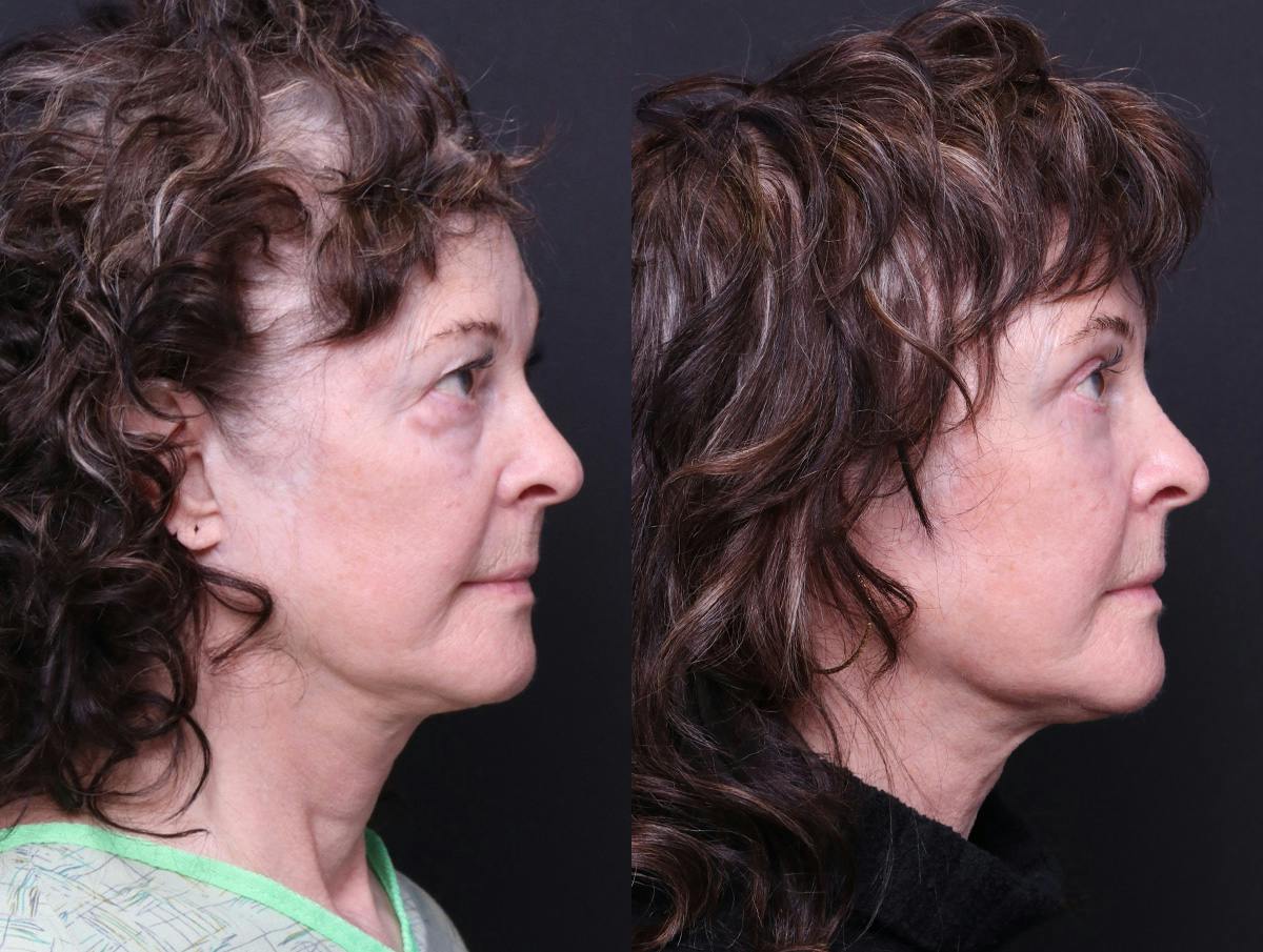 Blepharoplasty Before & After Gallery - Patient 238919 - Image 3