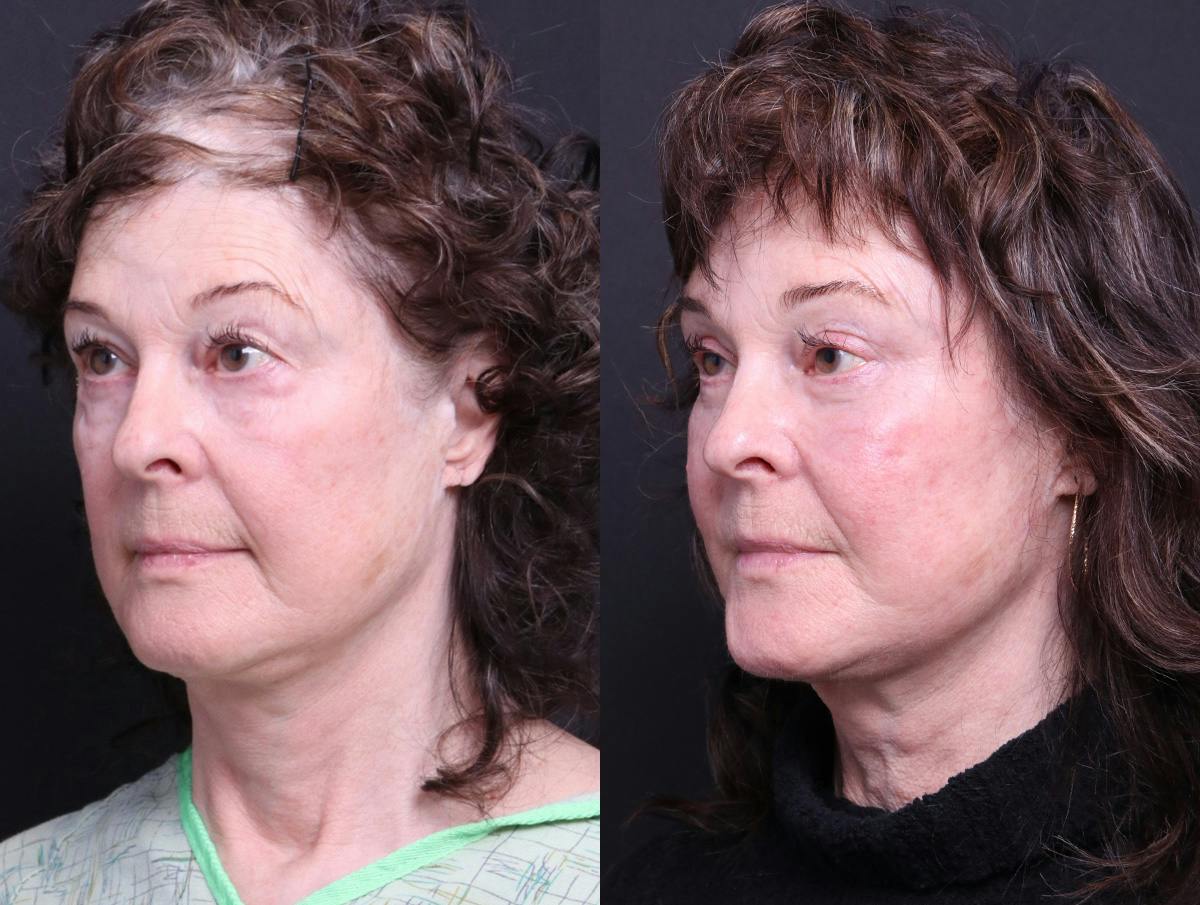Blepharoplasty Before & After Gallery - Patient 238919 - Image 4