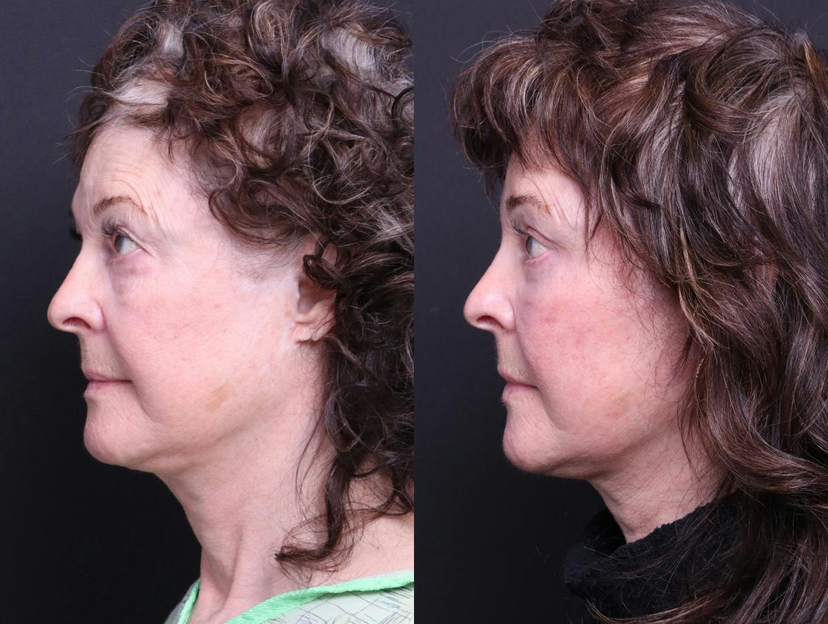 Blepharoplasty Before & After Gallery - Patient 238919 - Image 5