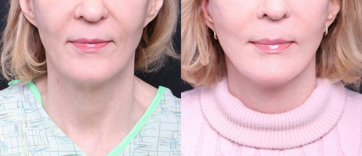 Deep Plane Facelift Before & After Gallery - Patient 674319 - Image 1