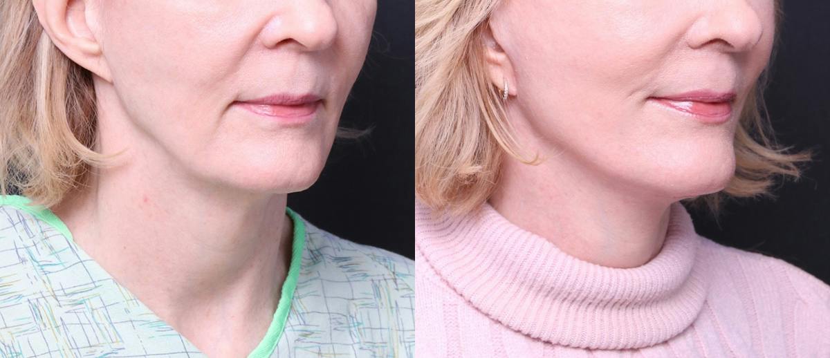 Deep Plane Facelift Before & After Gallery - Patient 674319 - Image 2