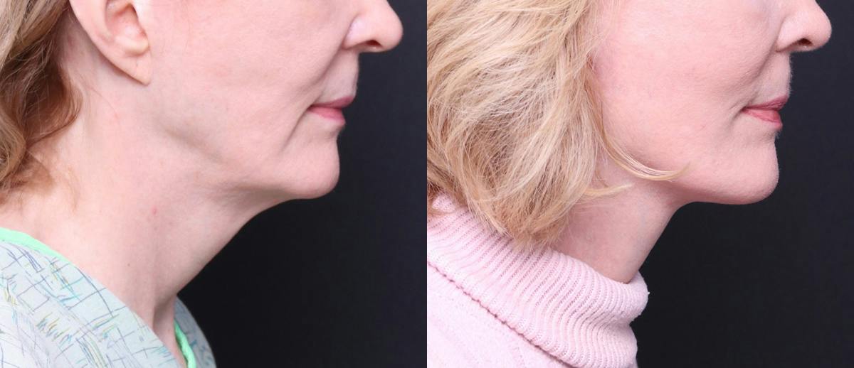 Deep Plane Facelift Before & After Gallery - Patient 674319 - Image 3